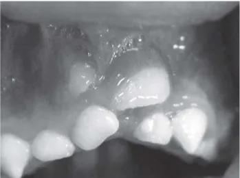FIGURE 2-  Ectopic position of the permanent maxillary central incisors