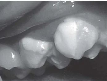FIGURE 4-  Panoramic radiograph exhibiting bilateral agenesis of the permanent maxillary lateral incisors and canines
