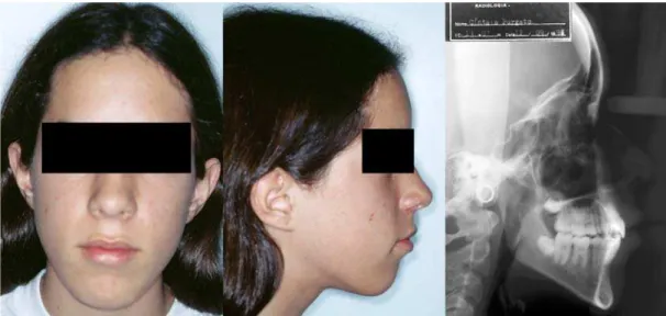 FIGURE 6- Frontal and lateral views at the end of treatment