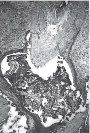 FIGURE 3- Periradicular cyst formation in a diabetic rat after 40 days of pulpal exposure