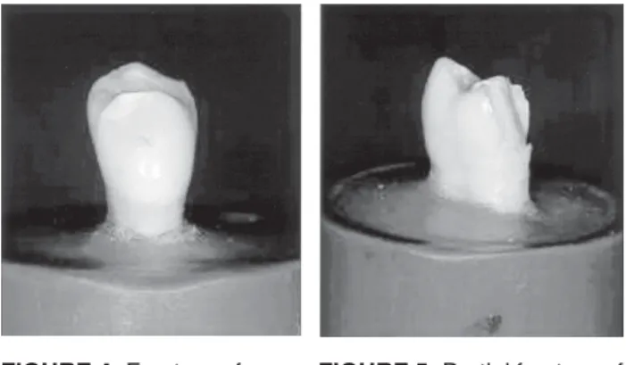 FIGURE 8- Fracture of the entire tooth crownFIGURE 4- Fracture of cusp