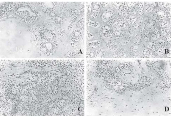 TABLE 1- Morphological pattern of the stroma of pleomorphic adenomas of the major and minor salivary glands