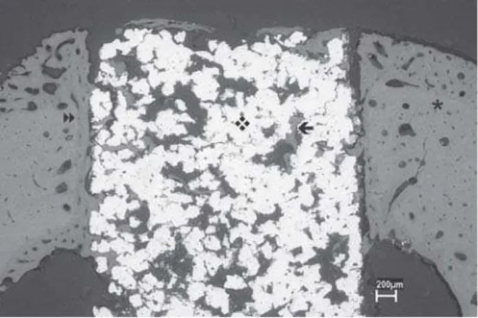 FIGURE 3- SEM micrograph showing a panoramic view of a cylindrical implant with porous surface (  ) inserted into rabbit tibia (  ); osseointegration at the bottom of the implant (  )