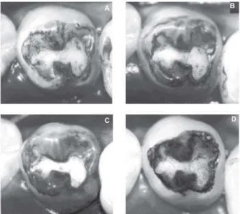 FIGURE 3- Photographs of specimen E38, left maxillary first premolar, presenting occlusal with the Prisma Shield sealant (S2), at the initial period (7 days) (T0) (A), 18 months (T1) (B), 36 months (T2) (C) and 11 years (T3) (D) after occlusal sealing