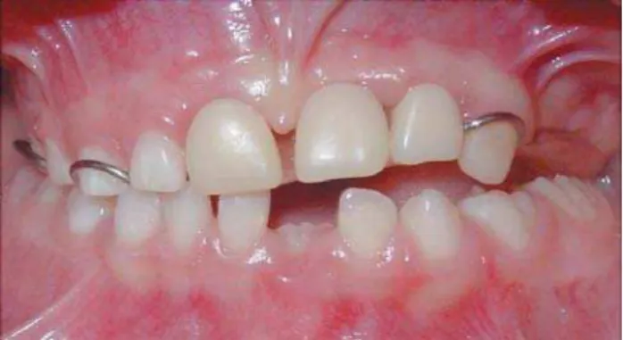 FIGURE 7- Panoramic radiograph showing the teeth with “ghostlike” appearance in maxillary left quadrant and the right permanent central incisor