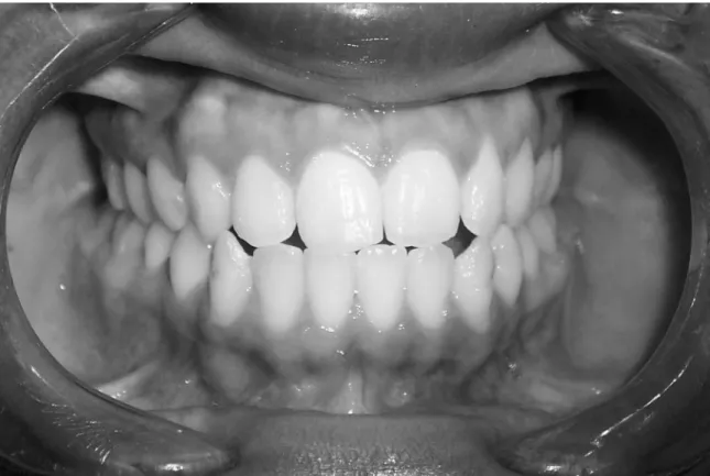 Fig 4: Fotografia frontal em oclusão.