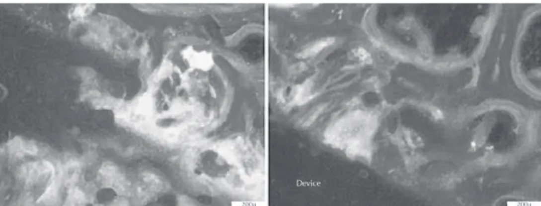 Figure 7. Microphotograph of undecalcified sections, unstained; the fluorochromes calcein (green)  and alizarin complexone (red) signal the areas of newly formed bone around one of the actuators  placed in the femur; picture on the left shows A4; picture o