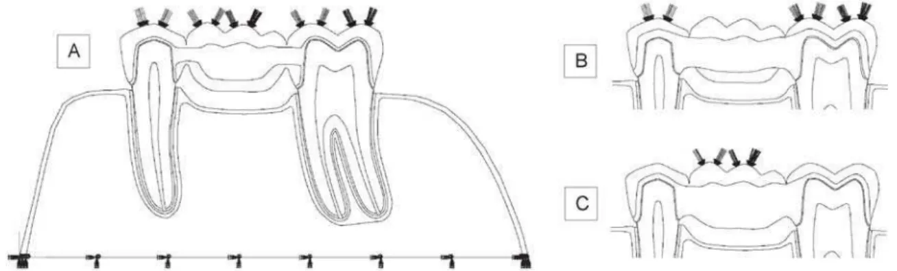 FIGURE 1- (A) Metal-ceramic FPD. The boundary conditions used for all models and the load applied distributed on all teeth (physiological load); (B) All-ceramic-OC FPD
