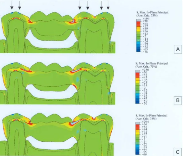 FIGURE 3- Stress distribution found when the load was applied only on the abutment teeth