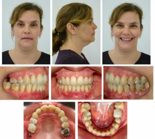 Figura 4 - Aspecto facial equilibrado e oclusão final da paciente evidenciando os resultados satisfatórios obtidos pelo tratamento.