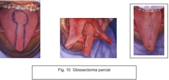 Fig. 10 Glossectomia parcial
