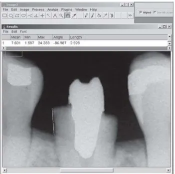 FIGURE 1-  Using ImageJ ® software, a parallel straight line (yellow line) to the root surface was drawn over the digital image to measure the distance from restorative margin to the marginal alveolar crest at mesial premolar site