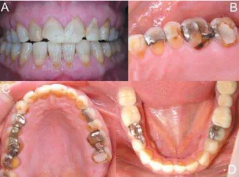 FIGURE 2-  Occlusal splint. A: front view, recovering vertical dimension of occlusion; B: anterior guidance; C: left lateral guidance; D: right lateral guidance