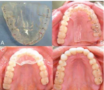 FIGURE 6-  Functional aspects of restored teeth. A: view of restored teeth immediately after restoration; B: protrusion;