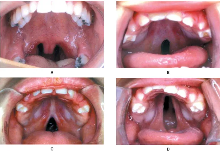 FIGURE 1- Different extents of isolated cleft palate: A) uvula, B) soft palate, C) incomplete hard palate and D) complete hard palate