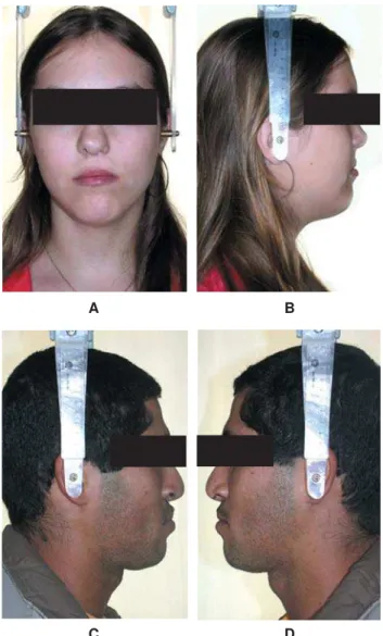 FIGURE 3- Patients with cleft lip and palate. Facial analysis in unilateral (A and B) and bilateral (C and D) cleft lip and palate in adult patients, operated at conventional ages and rehabilitated at HRAC/USP
