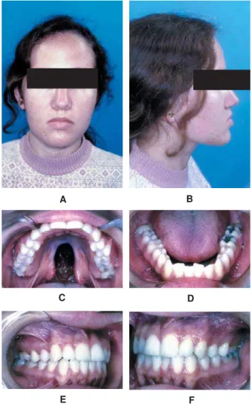 FIGURE 5- Patient with isolated cleft palate. Frontal and lateral facial analyses and occlusal analysis of adult patient with isolated cleft palate not previously rehabilitated