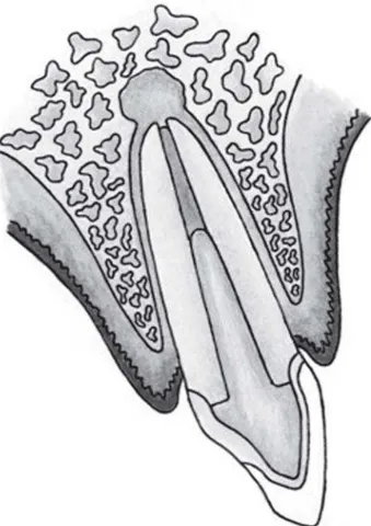 FIGURE 3- Schematic drawing of an endodontically treated tooth with periapical lesion