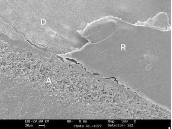 FIGURE 2- Failure in dentin of a specimen treated with self- self-etching adhesive system - Original magnification 500x (R – restoration; D – dentin; A – adhesive layer)