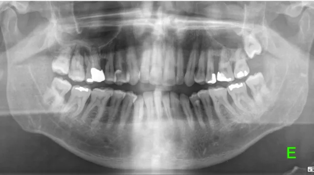 Figura 2: Observação de perda óssea radiográfica associada a doença periodontal. 