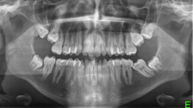 Figura 6: Radiografia panorâmica evidenciando dentes inclusos. 