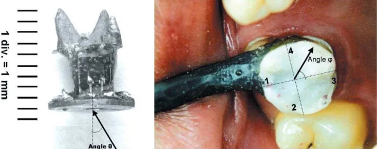 FIGURE 2- Pressure distribution in the premolar occlusal plane