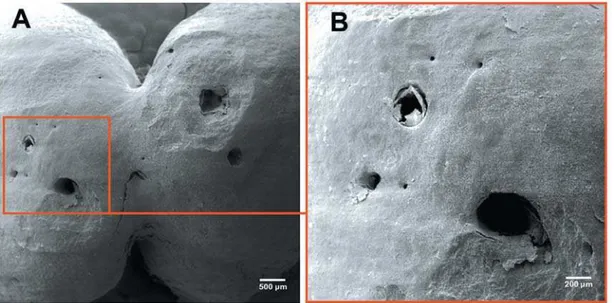 FIGURE 3- Severe club shape hypercementosis. Root apex of a maxillary molar, showing the presence of 2 apical foramina