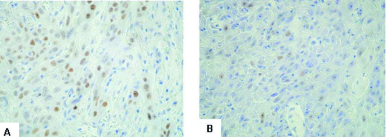 FIGURE 2-  Immunohistochemical staining. A: Immunohistochemical staining for pRb in OSCC