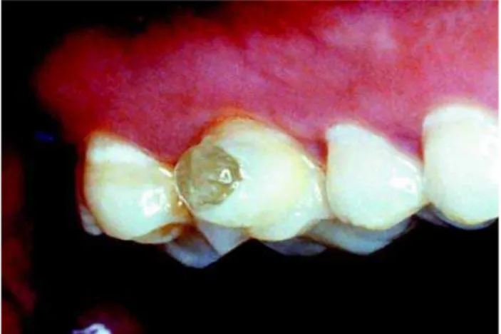 FIGURE 4- The latest version of the fluoride glass slow- slow-release device and plastic retention bracket