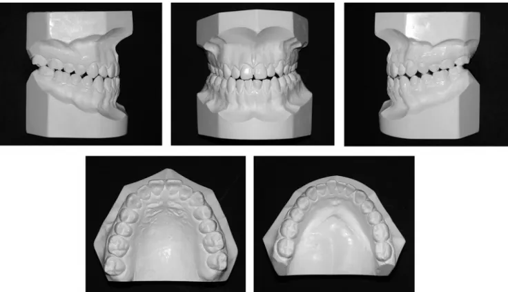 FIGURE 1- Pretreatment facial and intraoral photographs with the dental relationship in centric occlusion (patient signed informed consent authorizing the publication of these pictures)