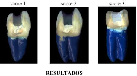 Tabela 1. Scores de infiltração do corante azul de metileno nos espécimes analisados por três diferentes examinadores (Ex.), de acordo com scores (0–3)