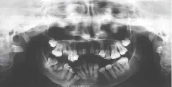 FIGURE 2-  Panoramic radiograph showing the oral health status