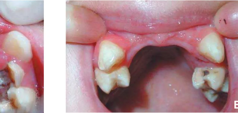 FIGURE 3-  A= Immediate (maxillary right central and lateral incisors) and 7-day (maxillary left central and lateral incisors) postoperative aspect
