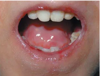 FIGURE 5-  Frontal view of open mouth. The limitation of mouth opening was a consequence of the microstomia