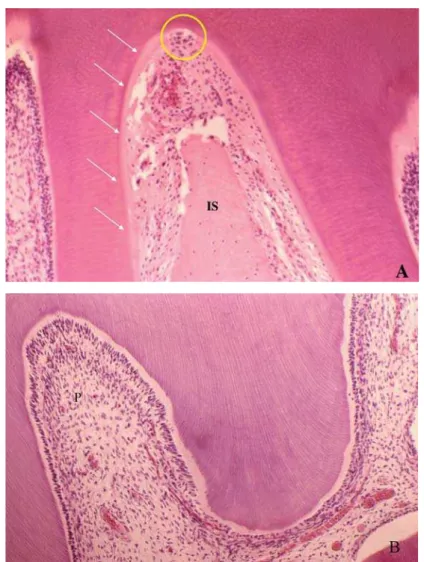 Figure 5- Microscopic aspects of the root pulp (P) in A, and coronal pulp in B, compatible with normal morphology of maxillary      '      Y ? Z  #     '   the cementoblast layer was extensively lost (arrows), with presence of several clasts and areas of r