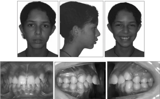Figura 2. Fotografias extrabucais iniciais - frontal, perfil e sorriso; Fotografias intrabucais iniciais - frontal, laterais direita e esquerda.