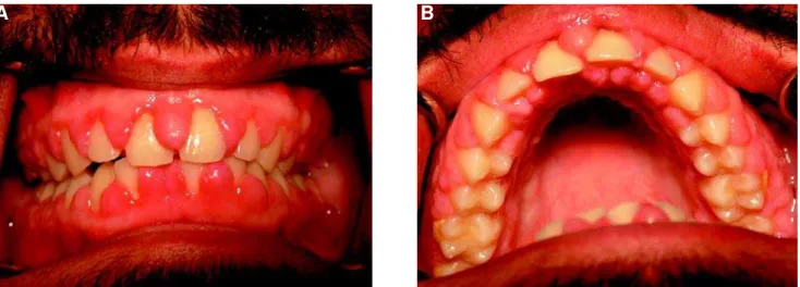 FIGURE 1-  Gingival enlargement affecting the buccal (A) and palatal (B) surfaces of all teeth