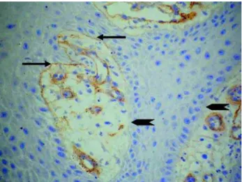 FIGURE 5-  TEM micrograph showing tonofilament clumping (arrow) (x27800)