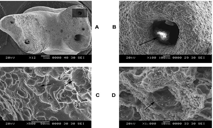 FIGURE 2  (A-D) -  Root resorption of permanent molar associated with periapical granuloma at 18x, 100x, 250x, 500x magnifications