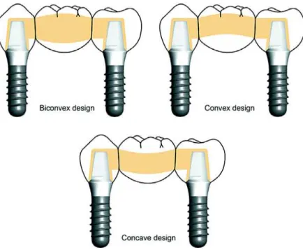 FIGURE 1- Pontic designs