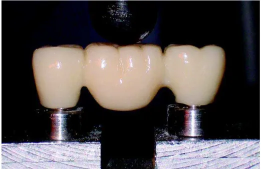 FIGURE 3- Example of a fractured fixed partial denture