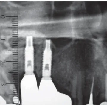 FIGURE 2- The same two implants after 24 months: there is a small bone resorption around the fixture neck