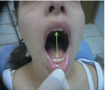 FIGURE 3-  Re-establishment of the normal jaw dynamics