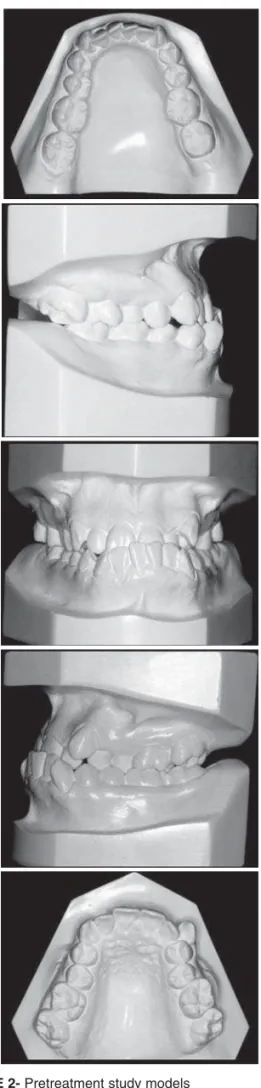 FIGURE 2-  Pretreatment study modelsFIGURE 1- Pretreatment facial and intraoral photographs