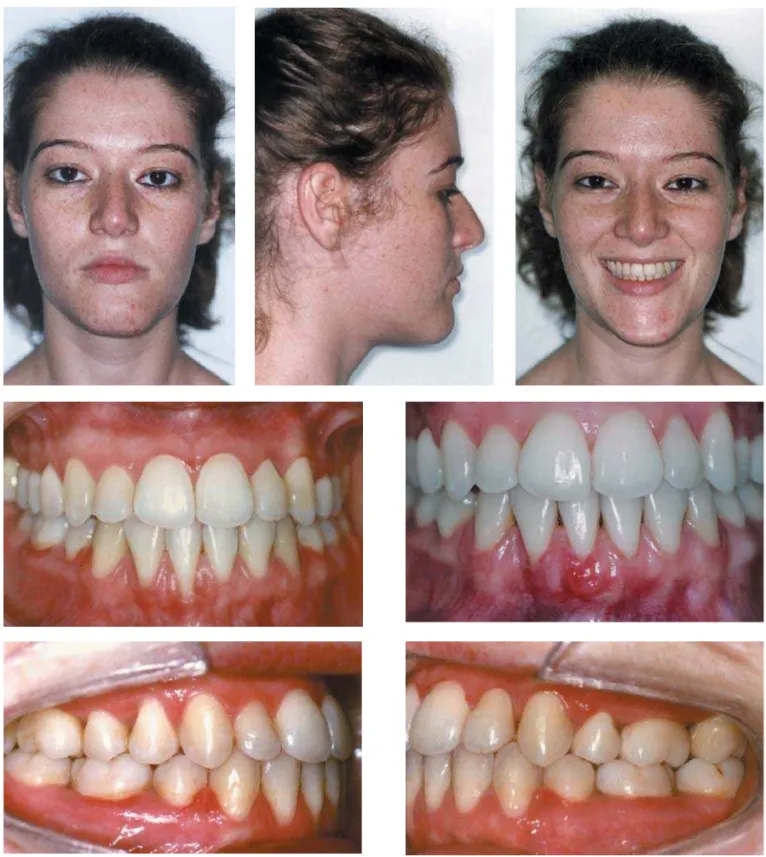 FIGURE 6-  Posttreatment facial and intraoral photographs. A functional canine Class I occlusion with good overbite and overjet was achieved