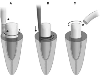 FIGURE 1- Procedures for intraradicular cast post removal.