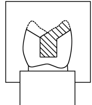 FIGURE 2- A) Half of the silicone matrix was placed on the tooth before cavity preparation; B) view after cavity preparation