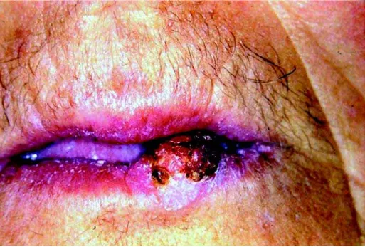 FIGURE 1-  Initial aspect of the patient, showing a nodular exophytic lesion in the inferior lip, with superficial ulceration and partial brown-pigmented crust covering