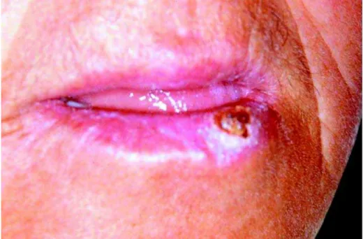 FIGURE 4-  Final aspect of the patient, two months after the second biopsy, showing complete involution of the lesion without significant scarring