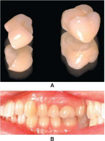 FIGURE 1-  A. Cercon ®  Zirconia crowns for the maxillary right second premolar and first molar